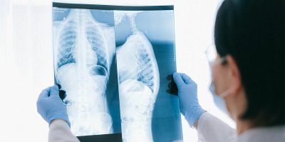 O aneurisma expande o diâmetro, também chamado de calibre, do vaso, o que causa danos às pared...