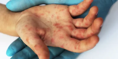QuÃ£o perigoso Ã© o sarampo? Sintomas para ficar de olho e como se proteger